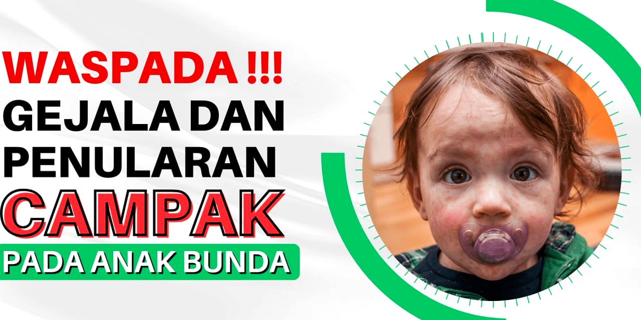 50 Suspek Campak di Solo, Hasil Lab Yogyakarta Menunggu