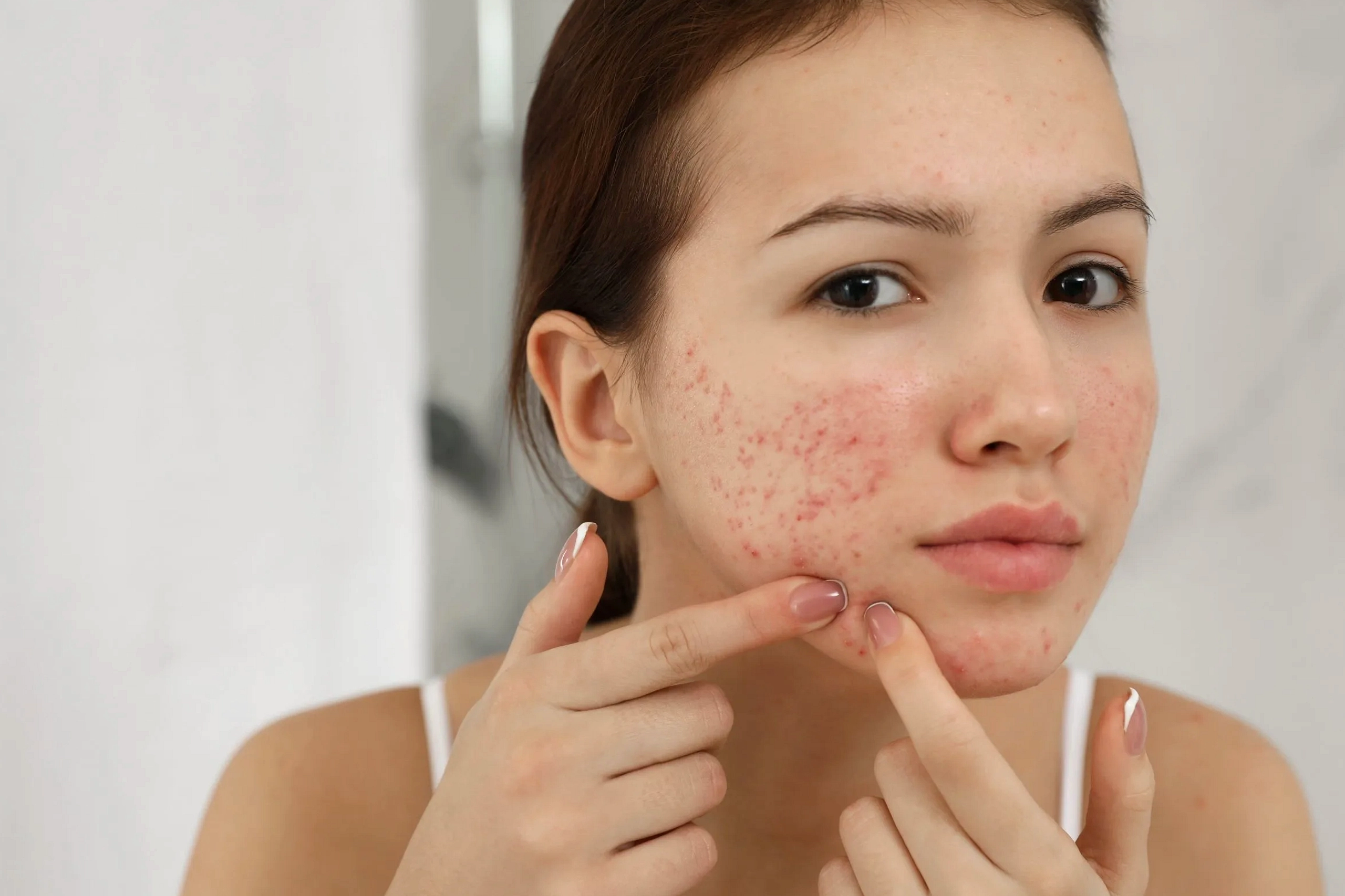 Diet dan Jerawat: Gula, Susu, dan Proses Memicu Kulit