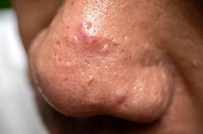 Dokter: Jangan Pernah Memencet Jerawat di Bawah Hidung