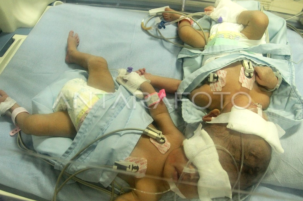 Empat Bayi Kembar Lahir di RSUD Sulbar