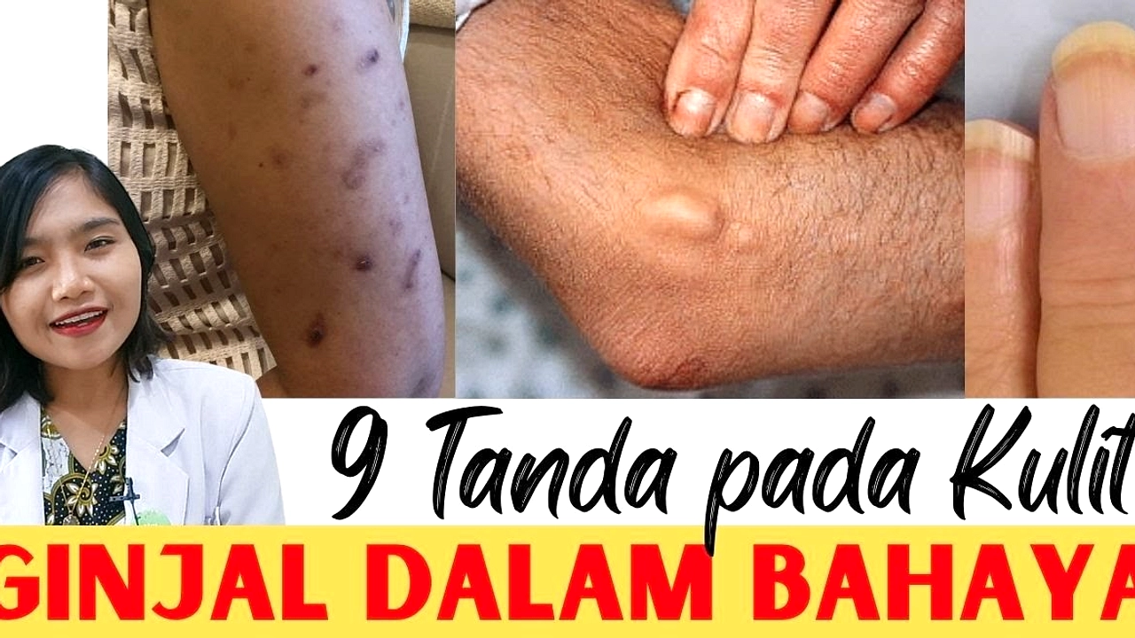 Gejala Awal Gagal Ginjal: Kaki Bengkak, Urin Berbusa