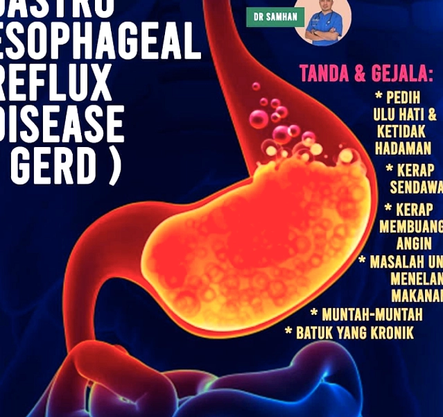 GERD: Risiko Jika Tidak Diobati Bisa Berujung Fatal