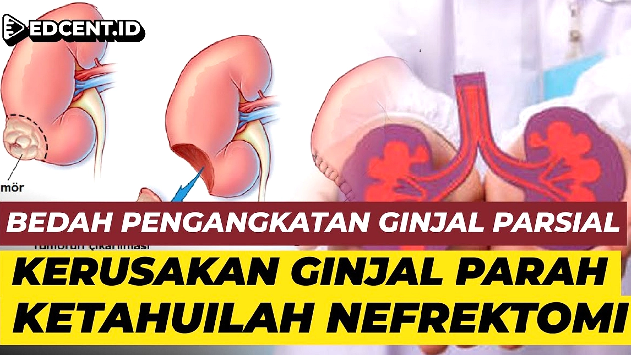 Kanker Ginjal 35 Tahun, Rizal Berjuang Satu Ginjal di TikTok