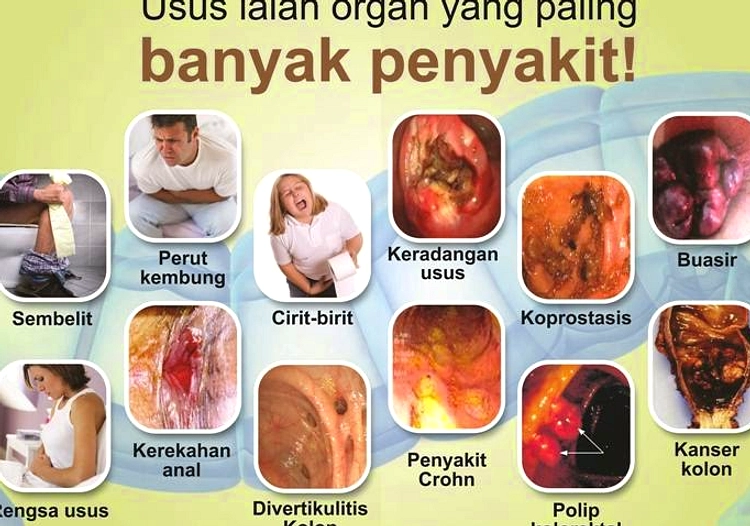 Panas Perut dan Susah Kentut, Waspada FODMAPs