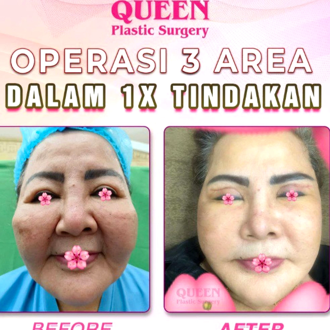 Pria 25 Tahun di AS Bayar Rp2,36 Miliar Operasi Peninggi Badan