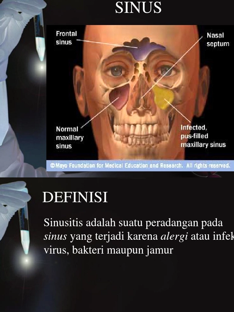 Sinusitis Sakit Kepala Sering Diabaikan, Cek di Mayapada