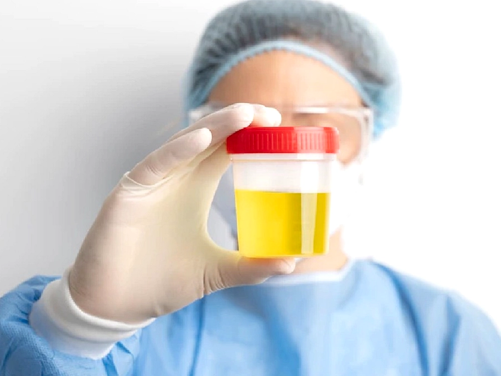 Urine Jernih Tak Selalu Sehat, Bisa Tanda Gangguan Ginjal