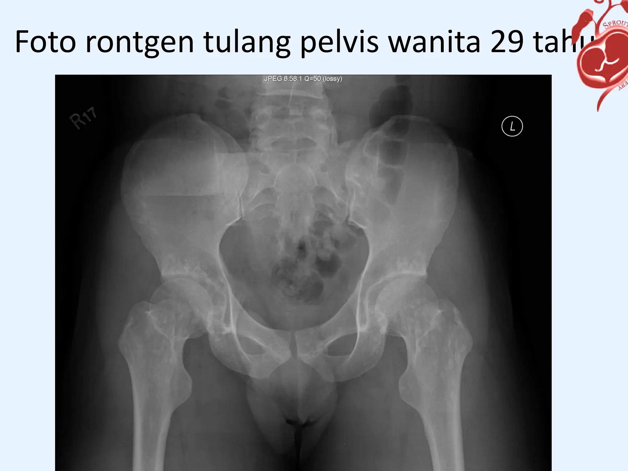 Wanita Taiwan Usus Besar Terpanjang, Operasi Diperlukan