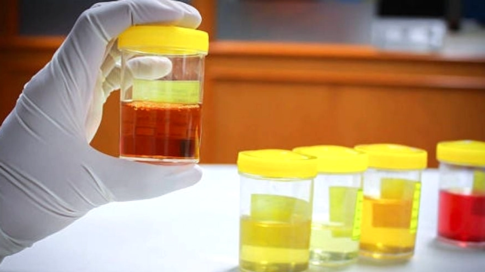 Warna Urine: Petunjuk Kesehatan Ginjal yang Perlu Diwaspadai